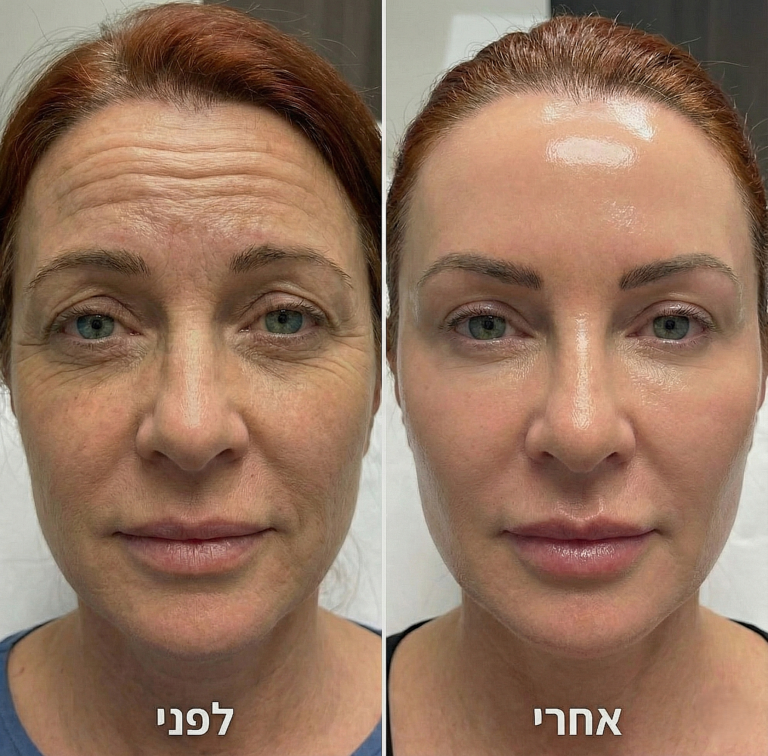 בוטוקס, קמטי הבעה, תמונה מתוך גלריית המרפאה, להמחשה כללית