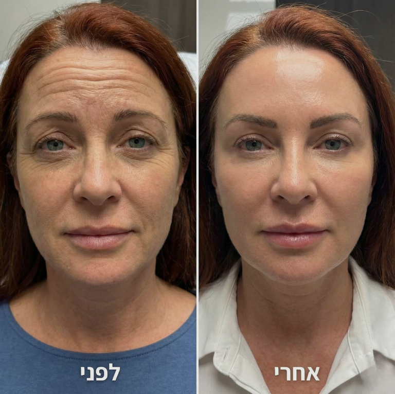 בוטוקס, קמטי הבעה, תמונה מתוך גלריית המרפאה, להמחשה כללית