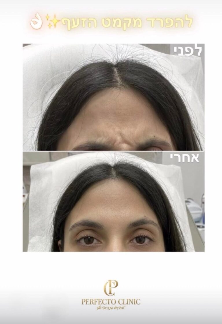 בוטוקס, קמטי הבעה, תמונה מתוך גלריית המרפאה, להמחשה כללית